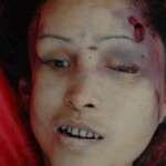 Examination and autopsy of Chinese woman with skull fracture