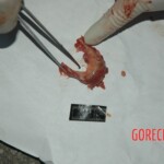 Examination and autopsy of Chinese woman with skull fracture