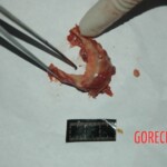 Examination and autopsy of Chinese woman with skull fracture