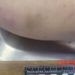 Hanged teen girl in morgue