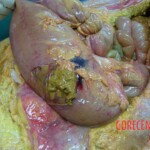 Peritonitis