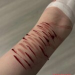 Shoushuii self-harm