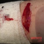 Self-harm of transgender boy