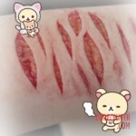 Self-harm of transgender boy