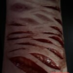 Self-harm of transgender boy