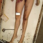 Slashed woman in morgue