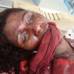 Dismembered woman in morgue