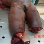 Dismembered woman in morgue