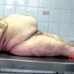 External examination of obese woman