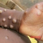 Mpox infection photo