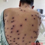 Mpox infection photo
