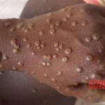 Mpox infection photo