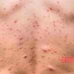 Mpox infection photo