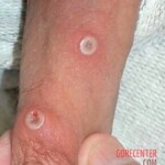 Mpox infection photo