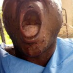 Mpox infection photo