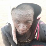 Mpox infection photo