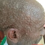 Mpox infection photo