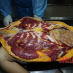 Examination and autopsy of Chinese woman stabbed to death