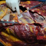 Examination and autopsy of Chinese woman stabbed to death