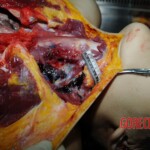 Examination and autopsy of Chinese woman stabbed to death