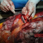 Examination and autopsy of Chinese woman stabbed to death