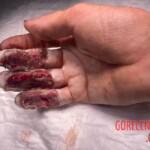 Painful work accident