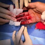 Painful work accident