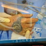 Painful work accident