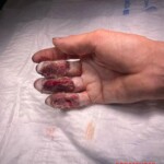 Painful work accident