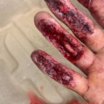 Painful work accident