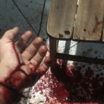 Suicide attemp by cutting wrist