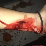 Suicide attemp by cutting wrist
