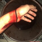 Suicide attemp by cutting wrist
