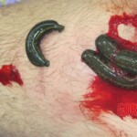 Alternative medicine with leeches