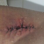 Alternative medicine with leeches