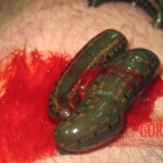 Alternative medicine with leeches