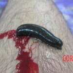 Alternative medicine with leeches
