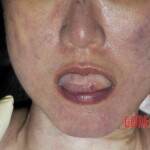 Female autoerotic asphyxiation