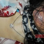 Female autoerotic asphyxiation