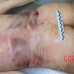 Autopsy of 18-year-old female suicidal jumper