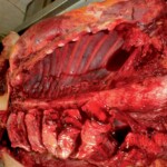 Autopsy of 18-year-old female suicidal jumper