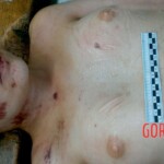 Autopsy of 18-year-old female suicidal jumper