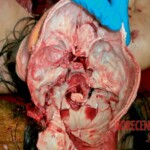 Autopsy of 18-year-old female suicidal jumper