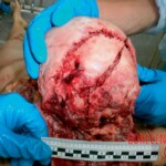 Autopsy of 18-year-old female suicidal jumper