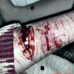 Cut to the bone on teenager's forearm