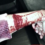 Cut to the bone on teenager's forearm