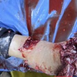 Foot crushed in meat grinder