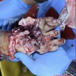 Foot crushed in meat grinder
