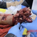 Foot crushed in meat grinder