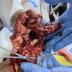 Foot crushed in meat grinder